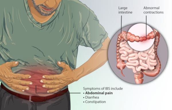 Depiction of a person suffering from Irritable Bowel Syndrome (IBS)